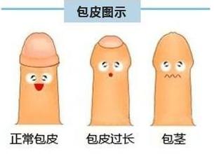 河池曙光男科医院割包皮怎么样？