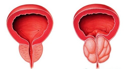 河池前列腺增生会不会复发